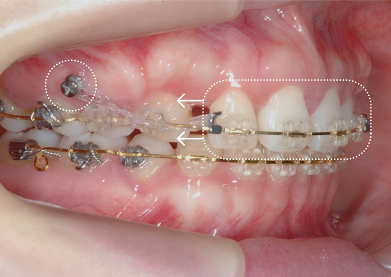 歯科矯正用アンカースクリューを用いた矯正