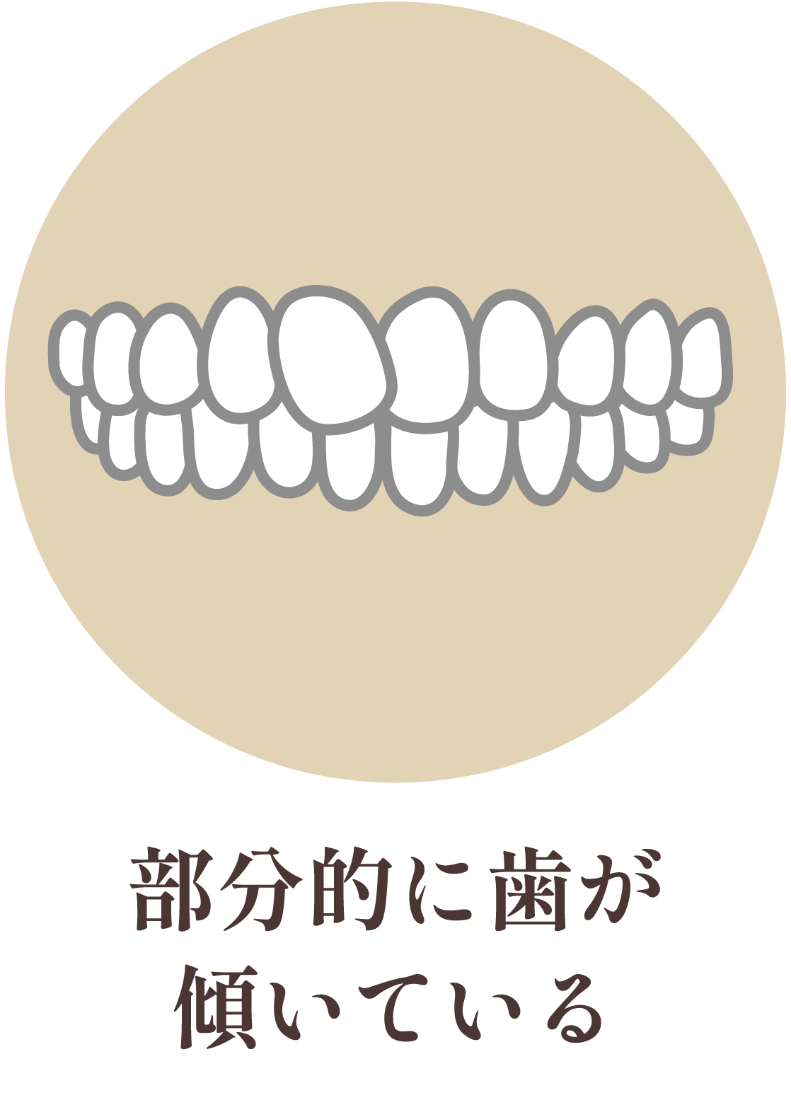 部分的に歯が傾いている