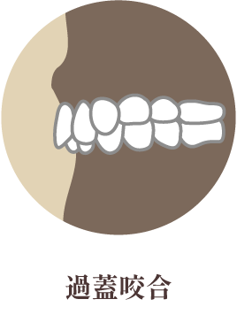 過蓋咬合